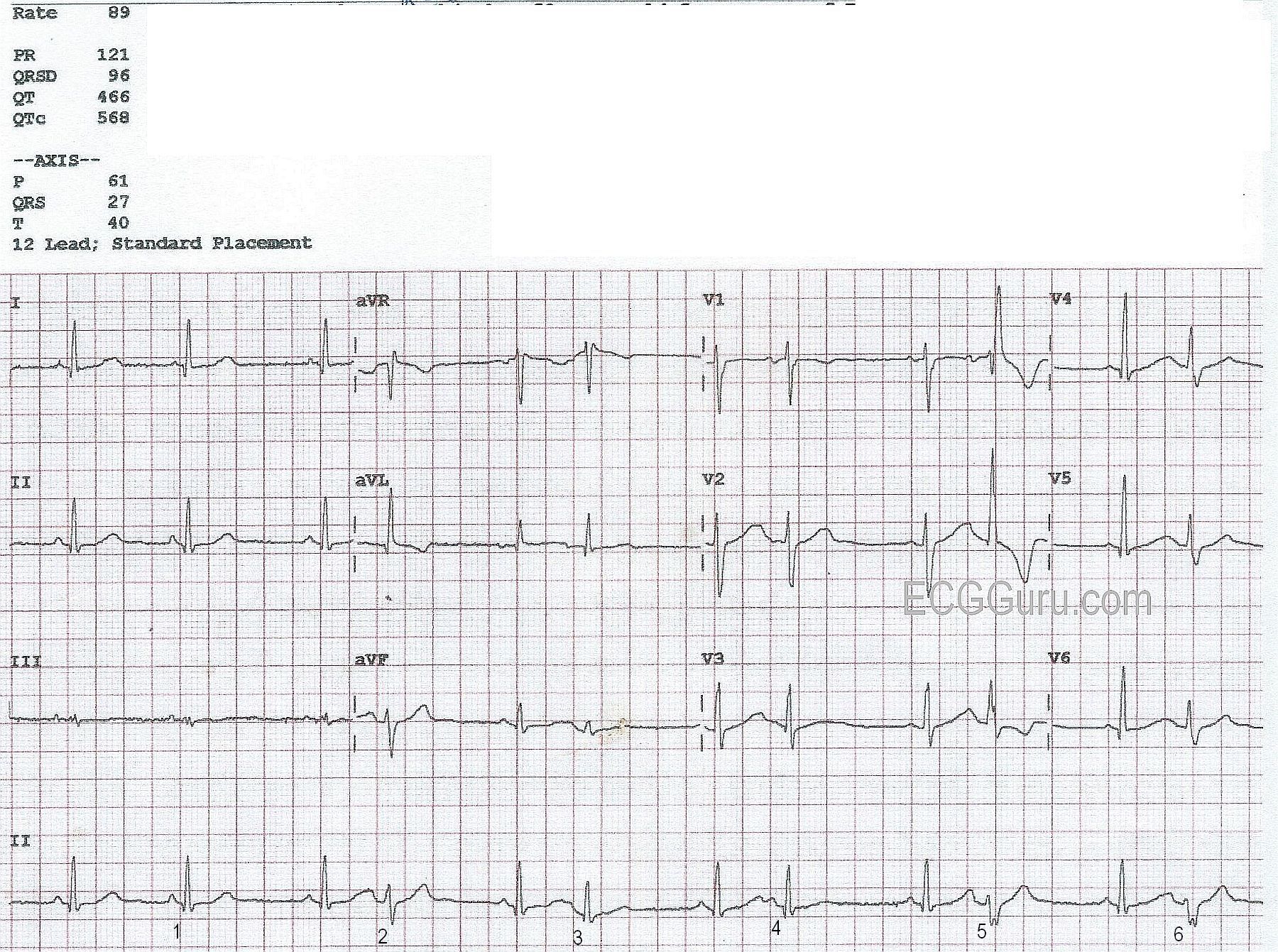 Bigeminal Rhythm With Aberrant Conduction ECG Guru Instructor Resources